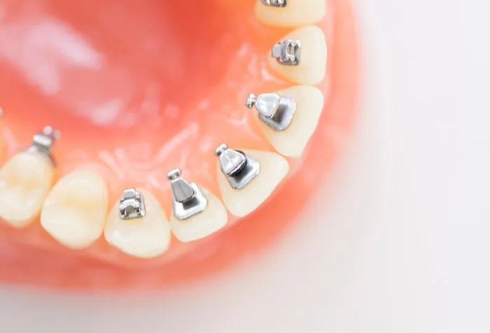 舌側矯正（リンガルブラケット矯正装置）
