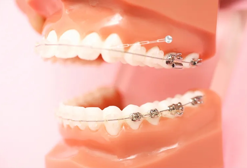 歯科矯正用アンカースクリューを用いた矯正歯科治療