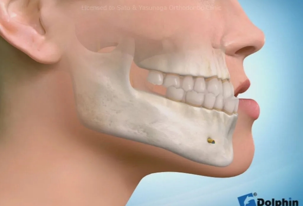 保険適用の外科的矯正